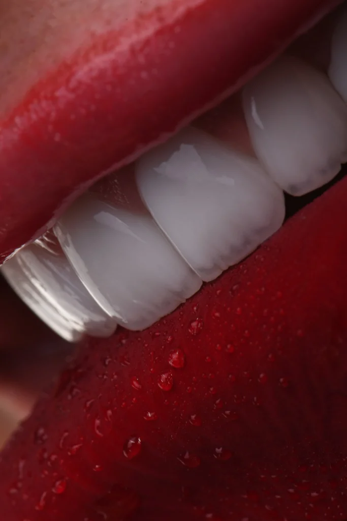 لمینیت سرامیکی دندان؛ راهی سریع و ماندگار برای لبخندی طبیعی، سفید و درخشان.