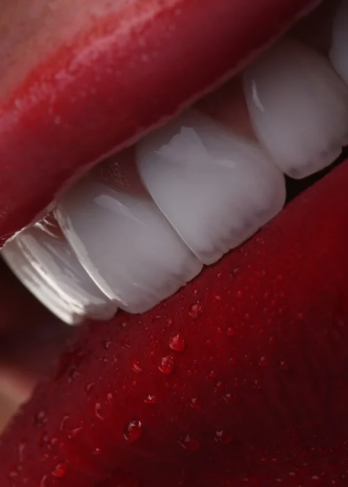 لمینیت سرامیکی دندان؛ راهی سریع و ماندگار برای لبخندی طبیعی، سفید و درخشان.