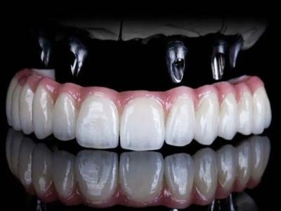 Exceptional Dental Implants_ A Guide to Perfect Smiles