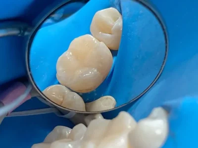 Restauración con resina dental